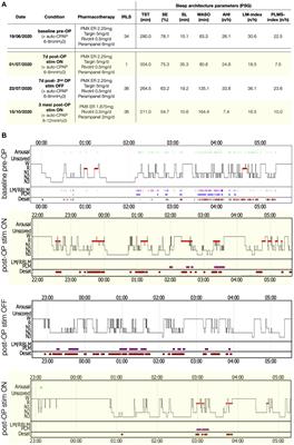 Spinal cord stimulation in severe pharmacoresistant restless legs syndrome—two case reports